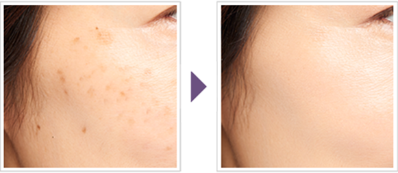 ผู้ที่มีกระเป็นจุดสีน้ำตาลเล็ก ๆ กระจายไปทั่วใบหน้า